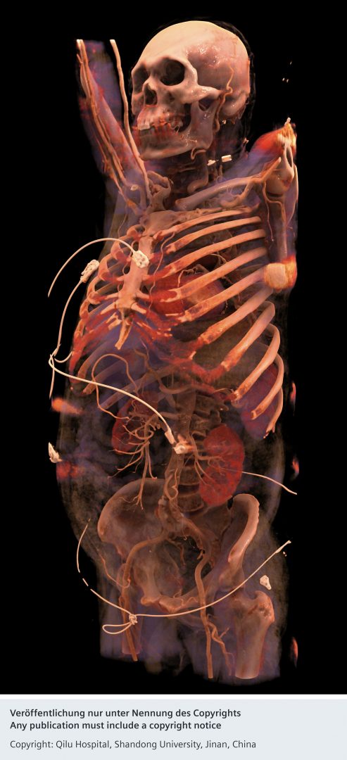 Human skeleton, cinematic rendering, from Qilu Hospital, China