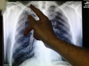 WATCH | 1M suspected TB cases in country