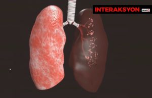 Lung_goodlung_badlung