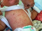 Child with measles