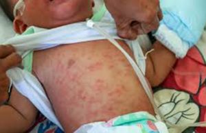 Child with measles