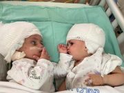 Born conjoined back-to-back, Israeli twins finally see each other after surgery
