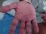 For those with HIV or weak immune systems, monkeypox can be fatal —U.S. study Monkeypox patient