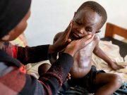 Mpox outbreak in Africa was neglected – it could now turn into the next global pandemic Child with mpox