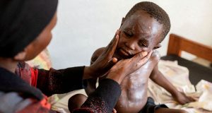 Child with mpox