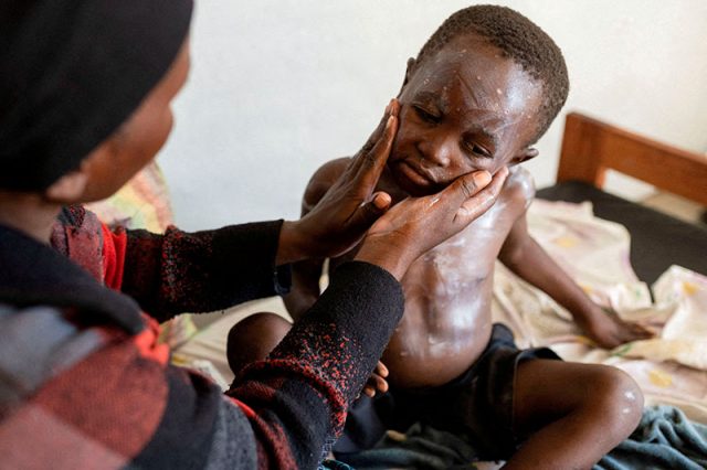 Child with mpox